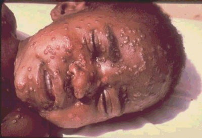 Smallpox2