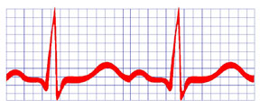 การตรวจคลื่นไฟฟ้าหัวใจ ECG