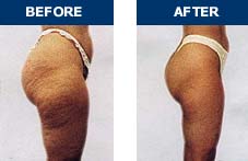 Endermologie Before & After Photo 3